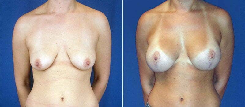 Breast Lift With Implants Before & After
