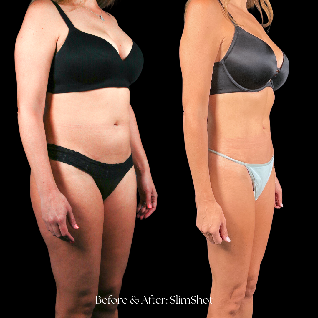SlimShot Before & After