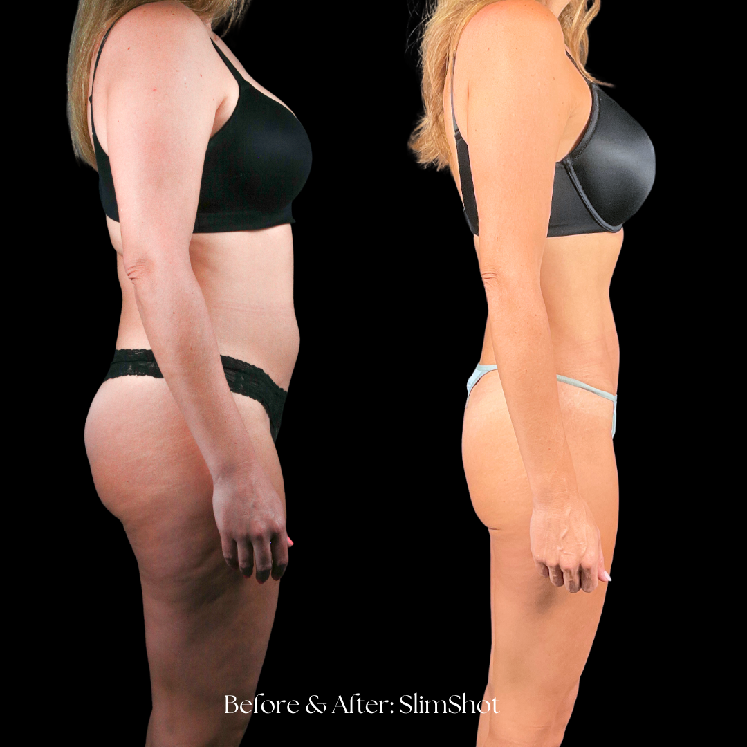 SlimShot Before & After
