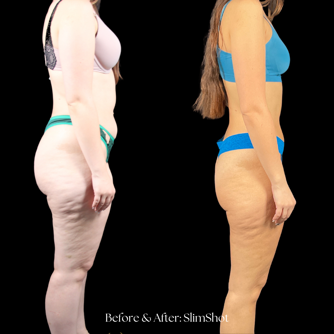 SlimShot Before & After