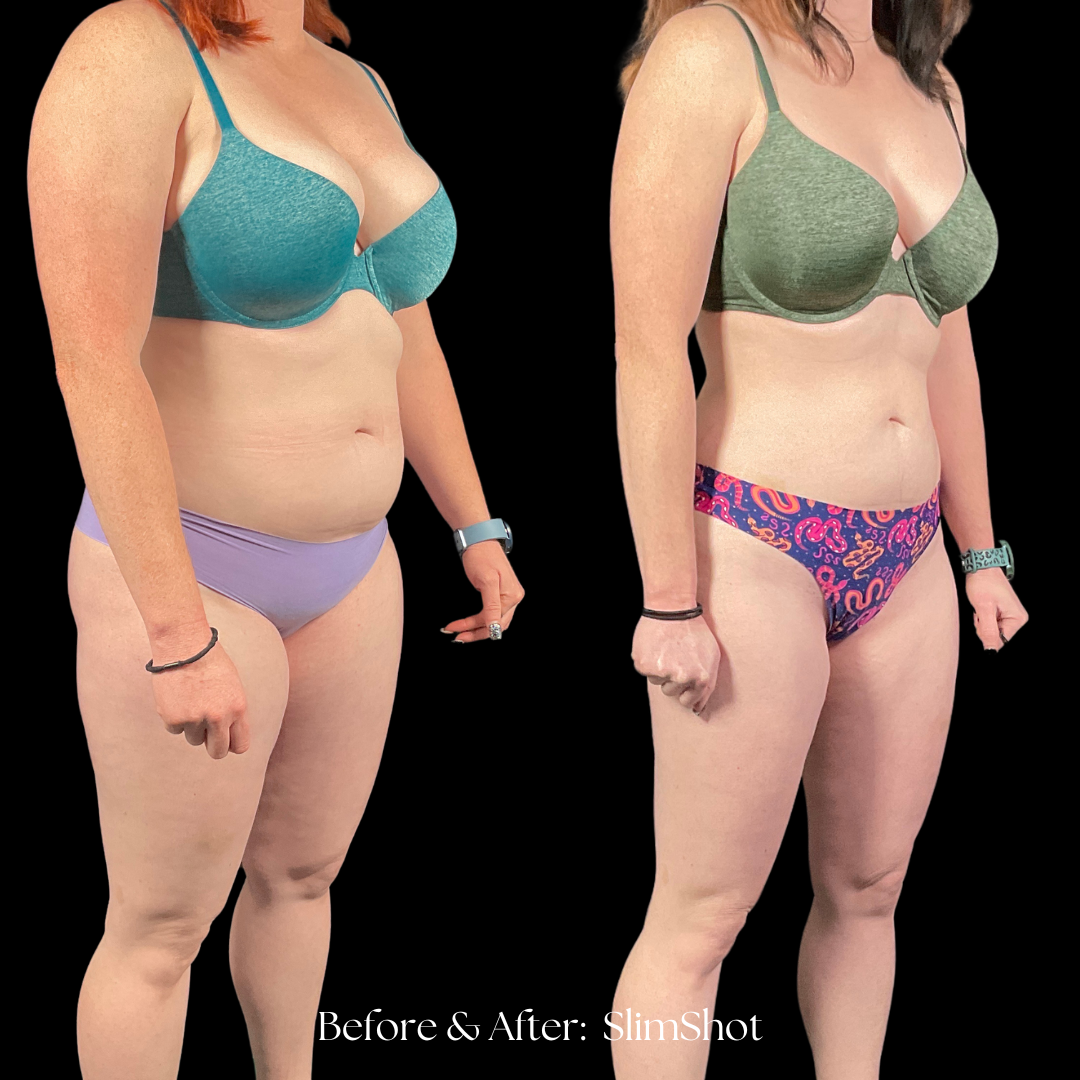 SlimShot Before & After
