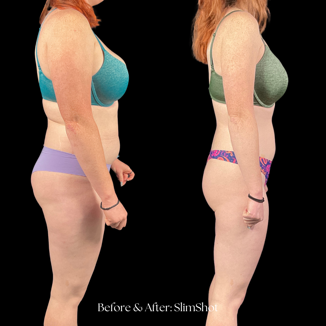 SlimShot Before & After