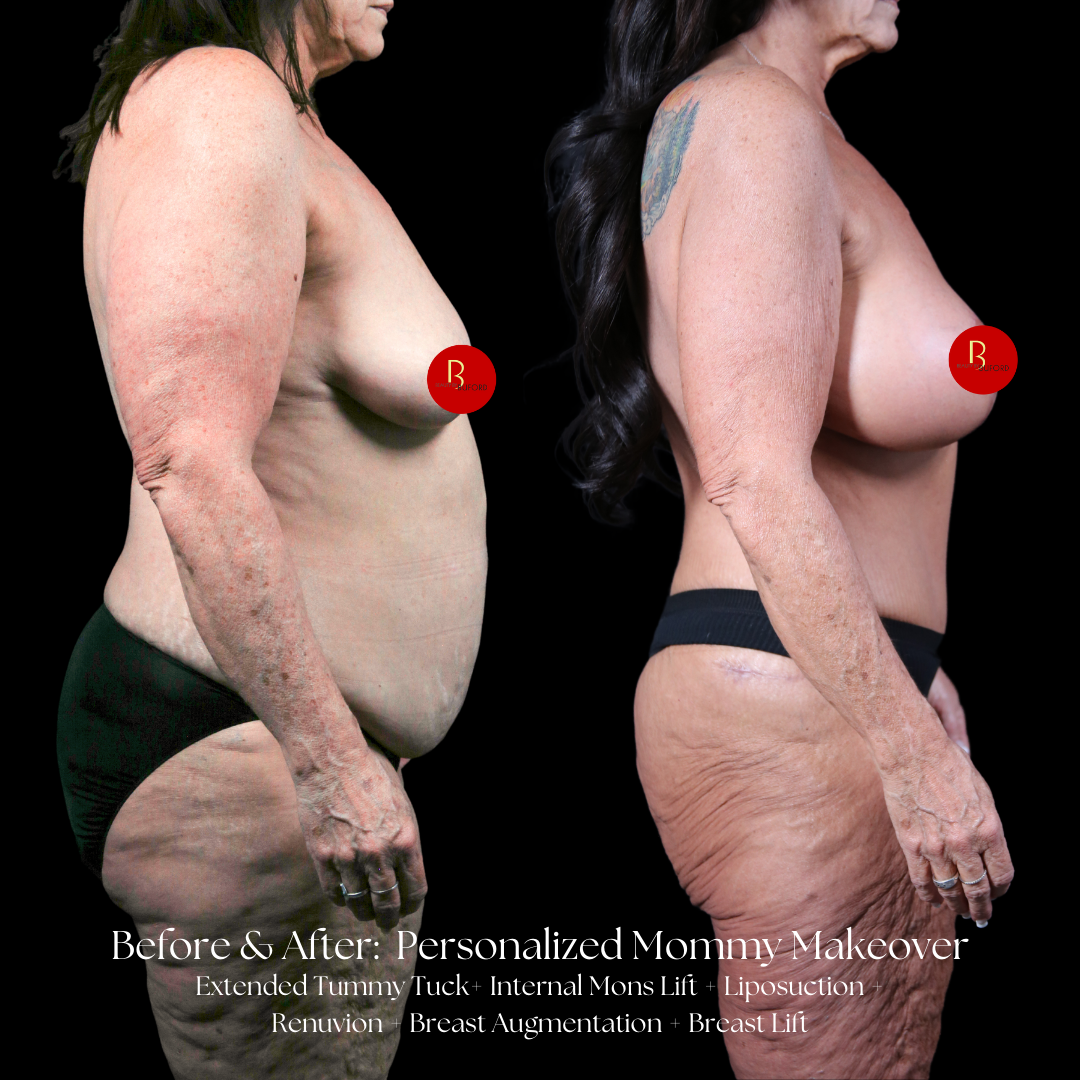 Mommy Makeover Before & After