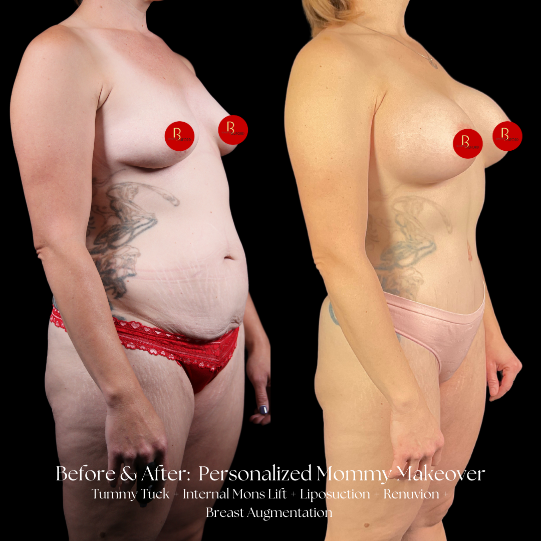 Mommy Makeover Before & After