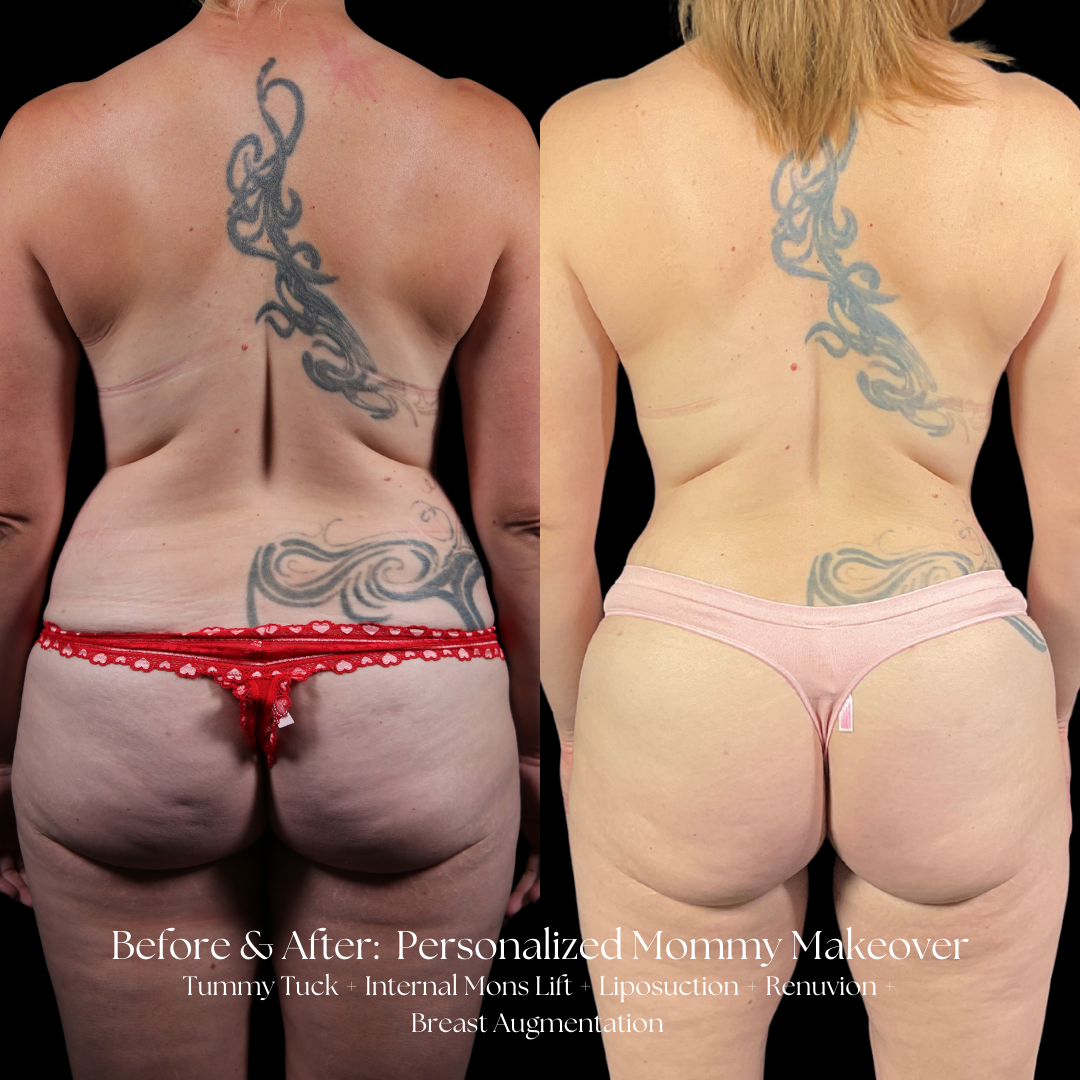 Mommy Makeover Before & After