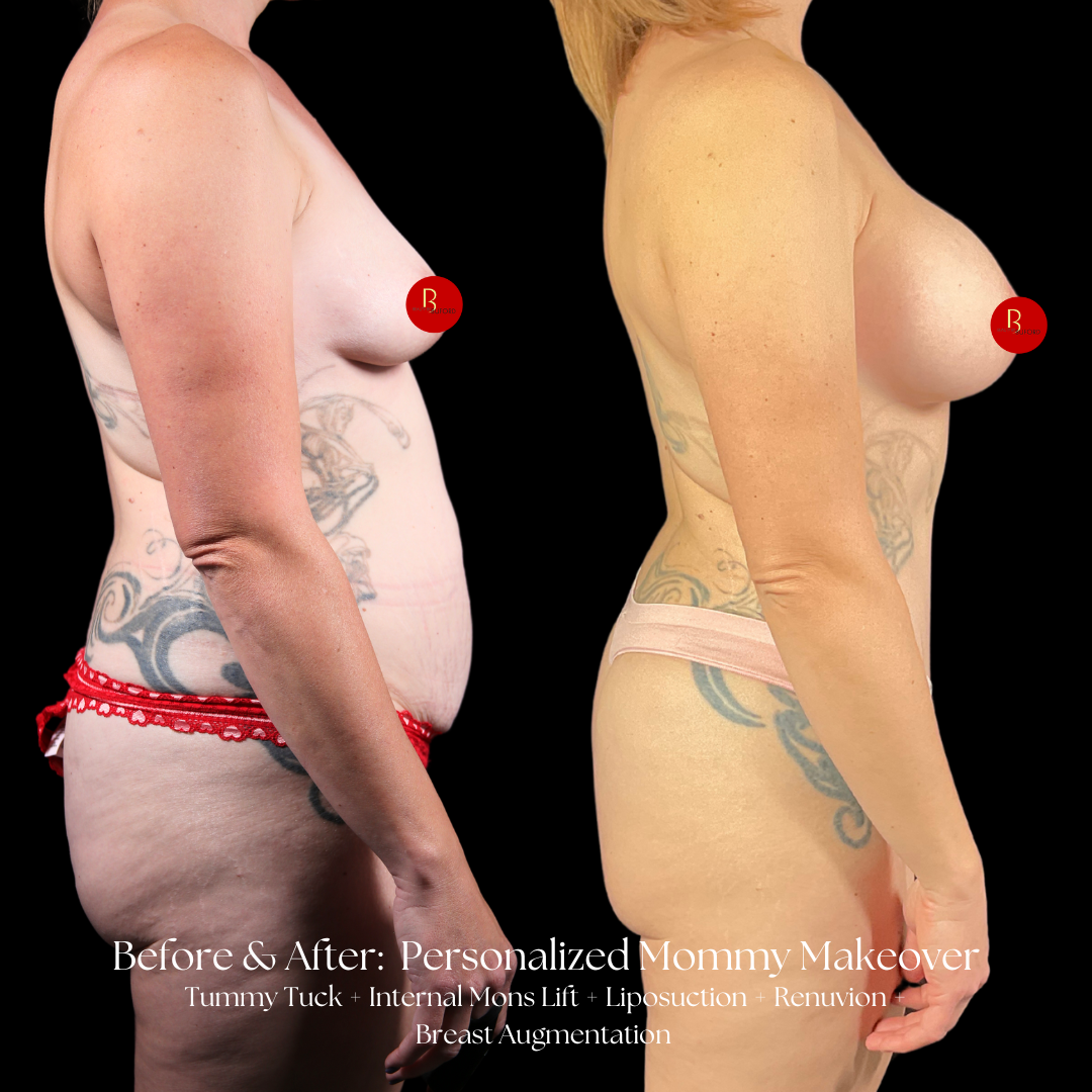 Mommy Makeover Before & After