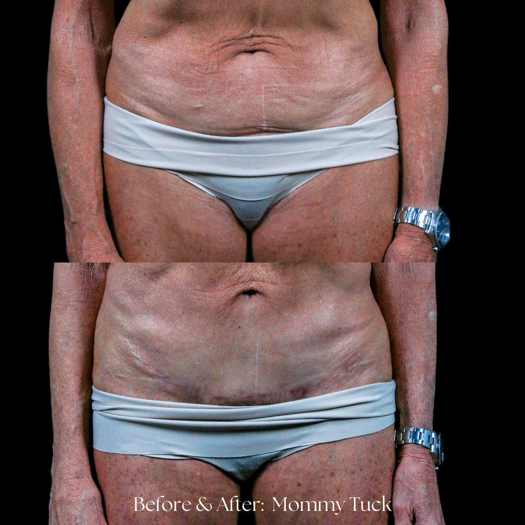 Tummy Tuck Before & After
