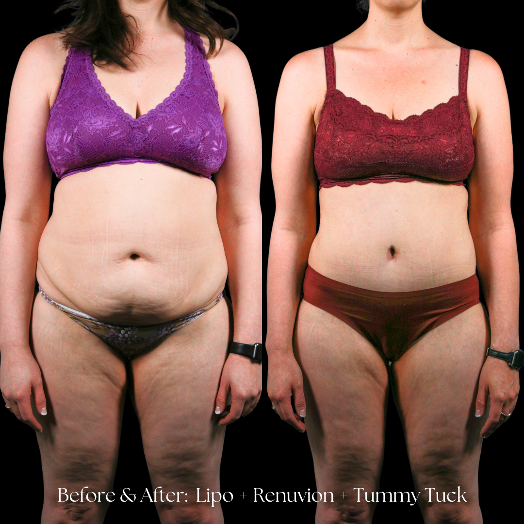 Tummy Tuck Before & After