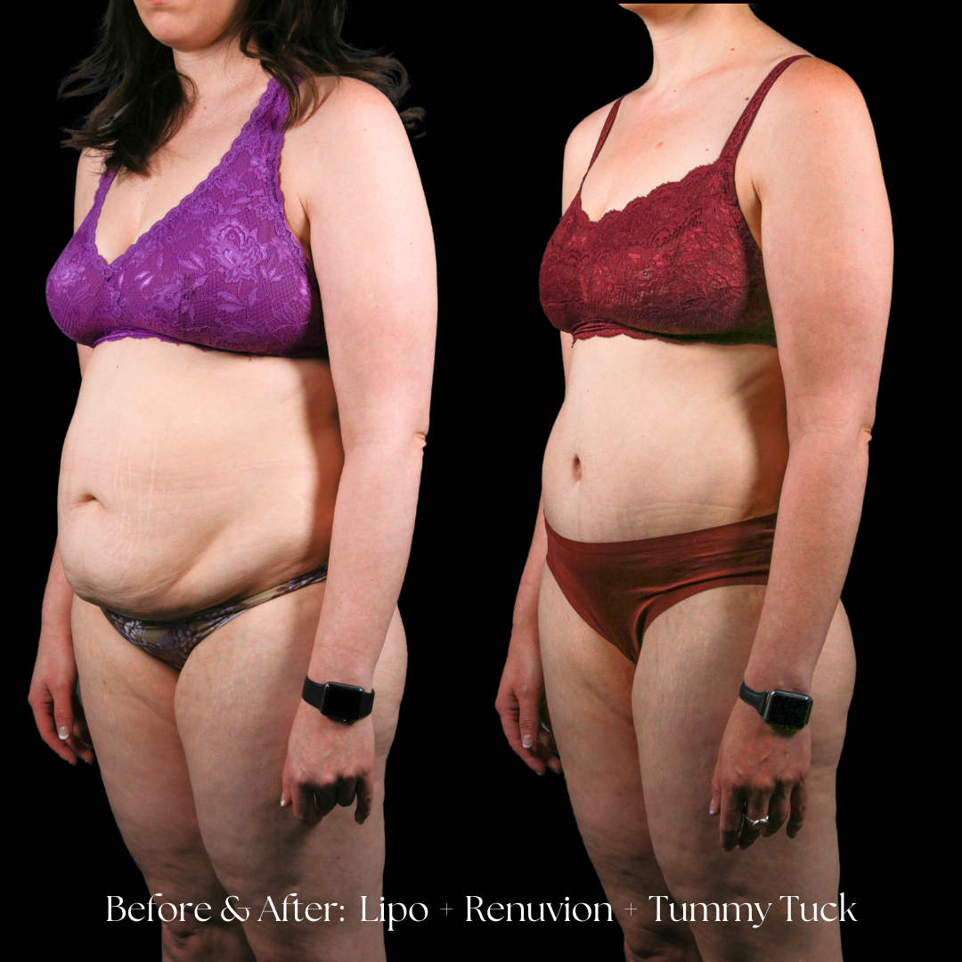 Tummy Tuck Before & After