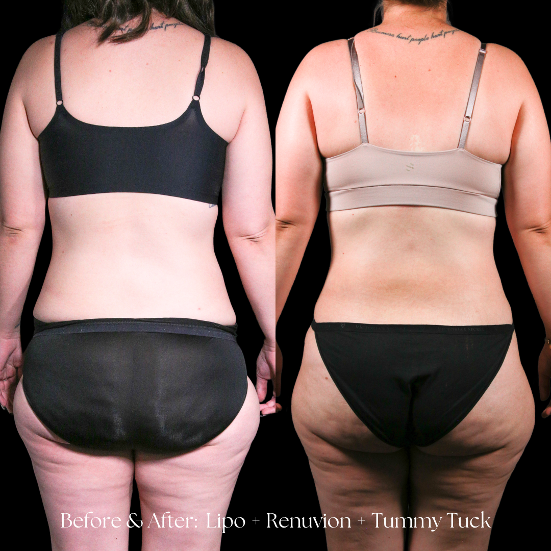 Tummy Tuck Before & After