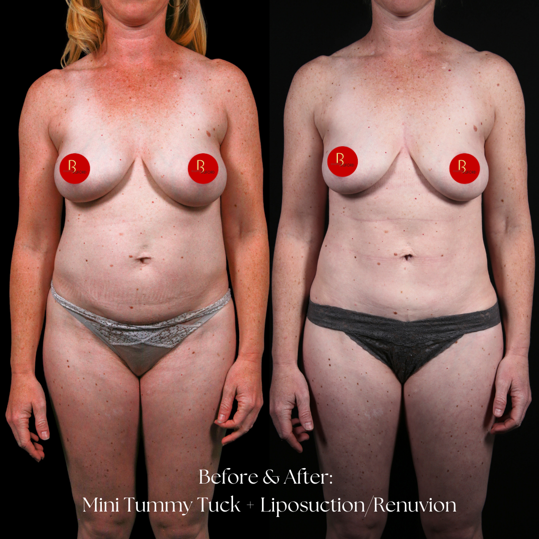 Tummy Tuck Before & After