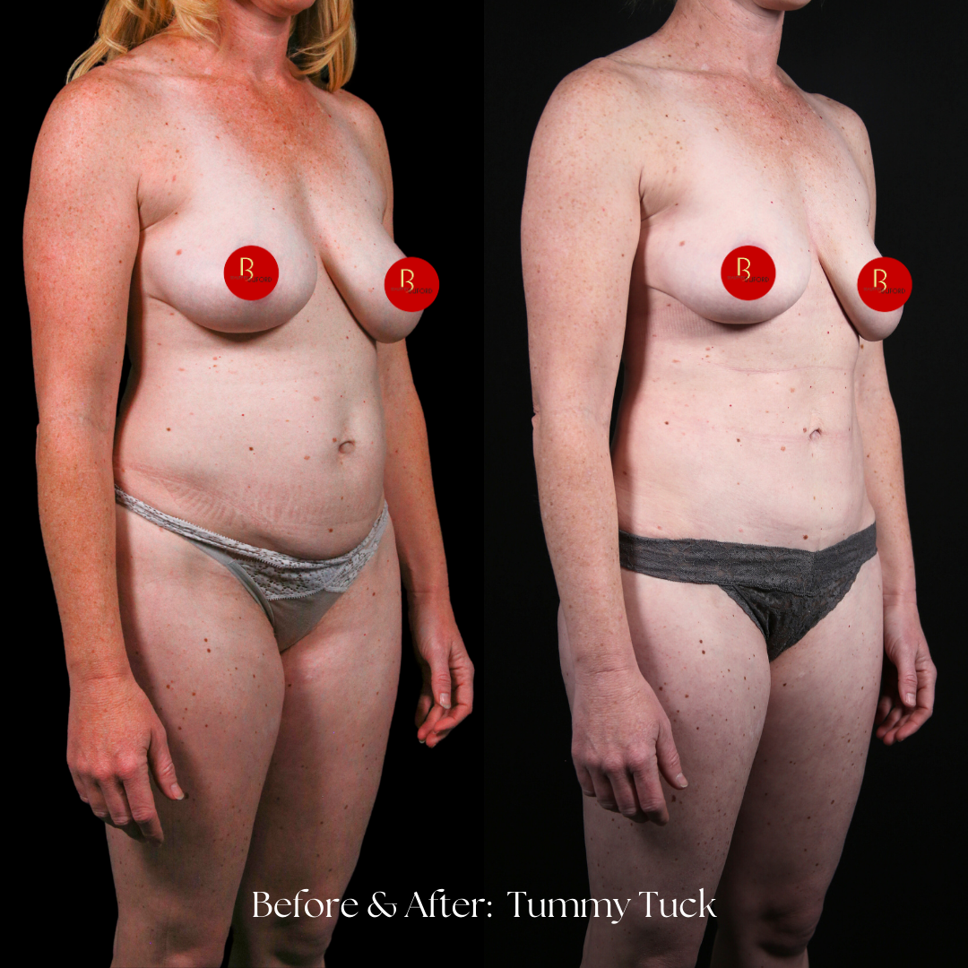 Tummy Tuck Before & After
