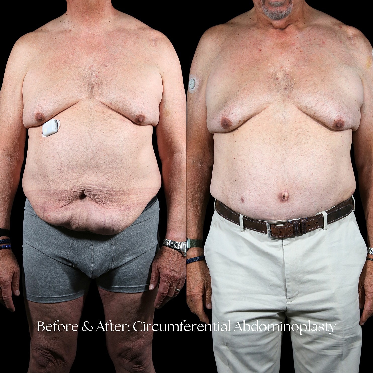 Tummy Tuck Before & After