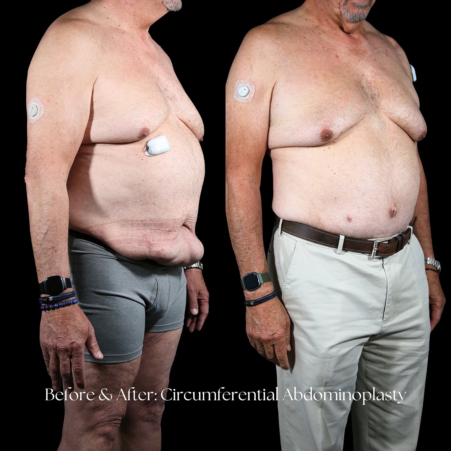 Tummy Tuck Before & After