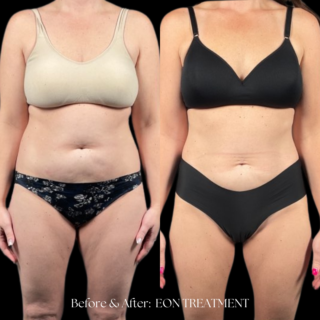 Eon Treatment Before & After