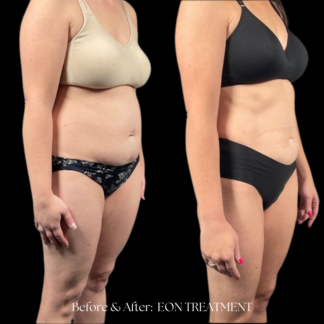 Eon Treatment Before & After