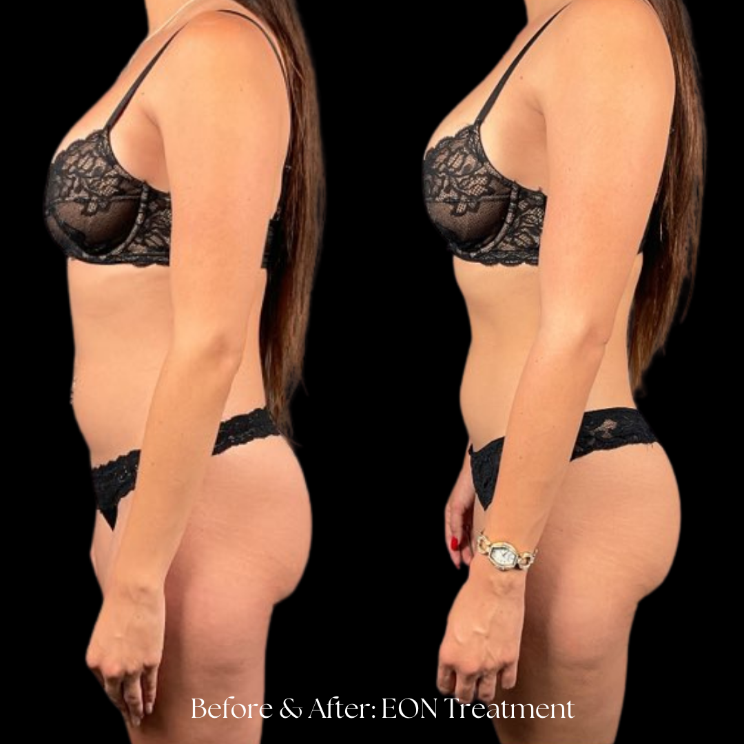 Eon Treatment Before & After