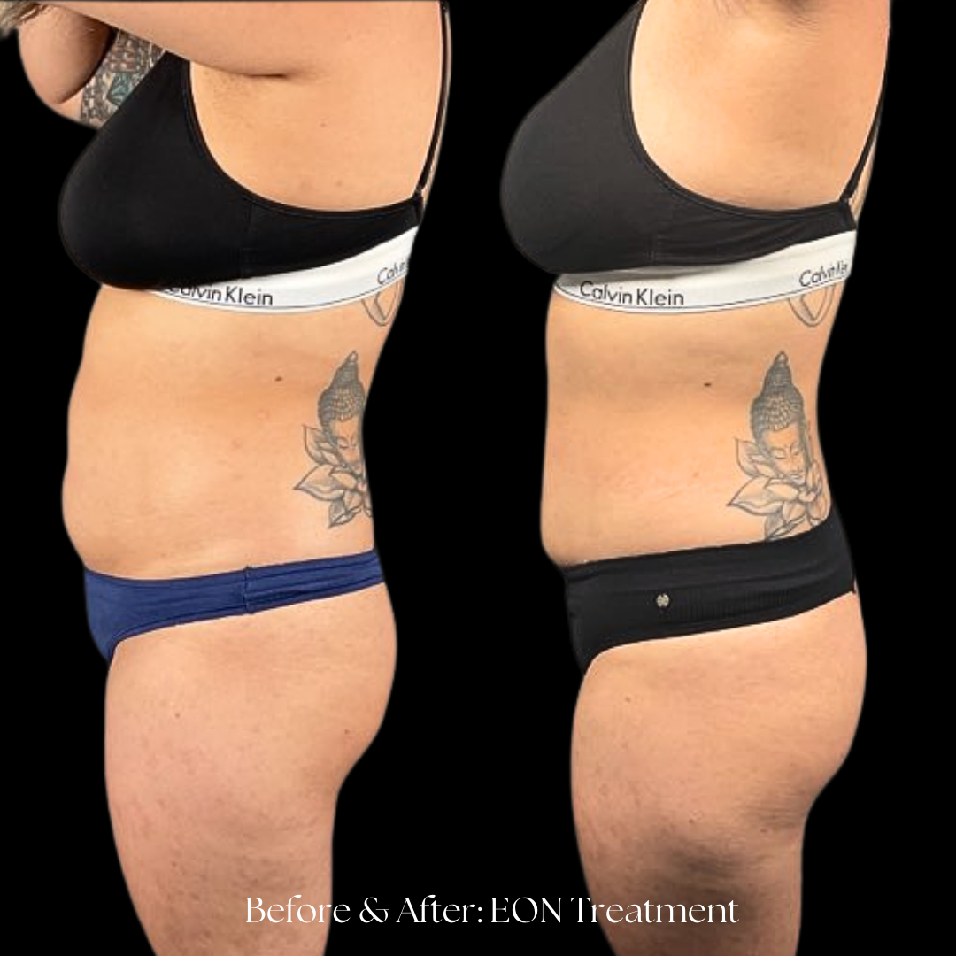 Eon Treatment Before & After