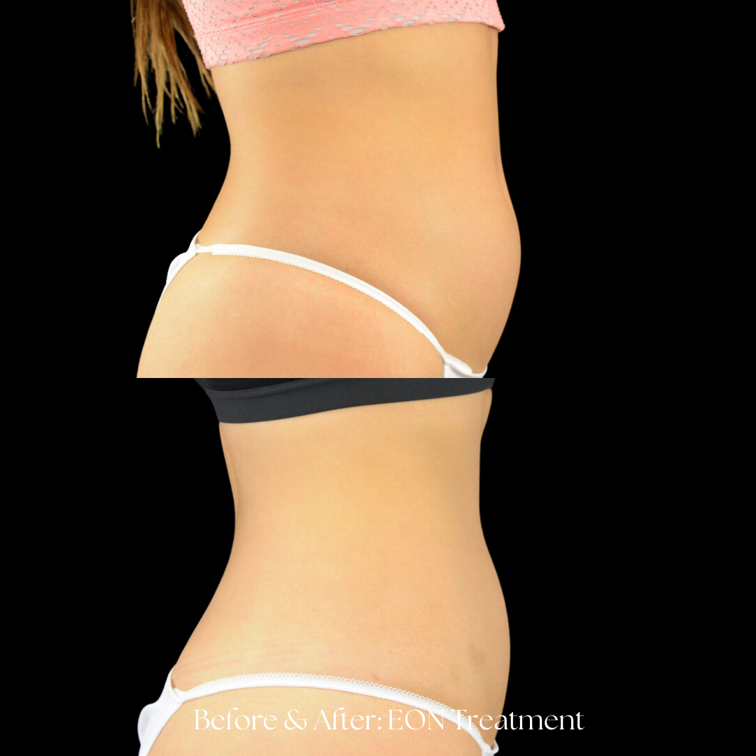 Eon Treatment Before & After
