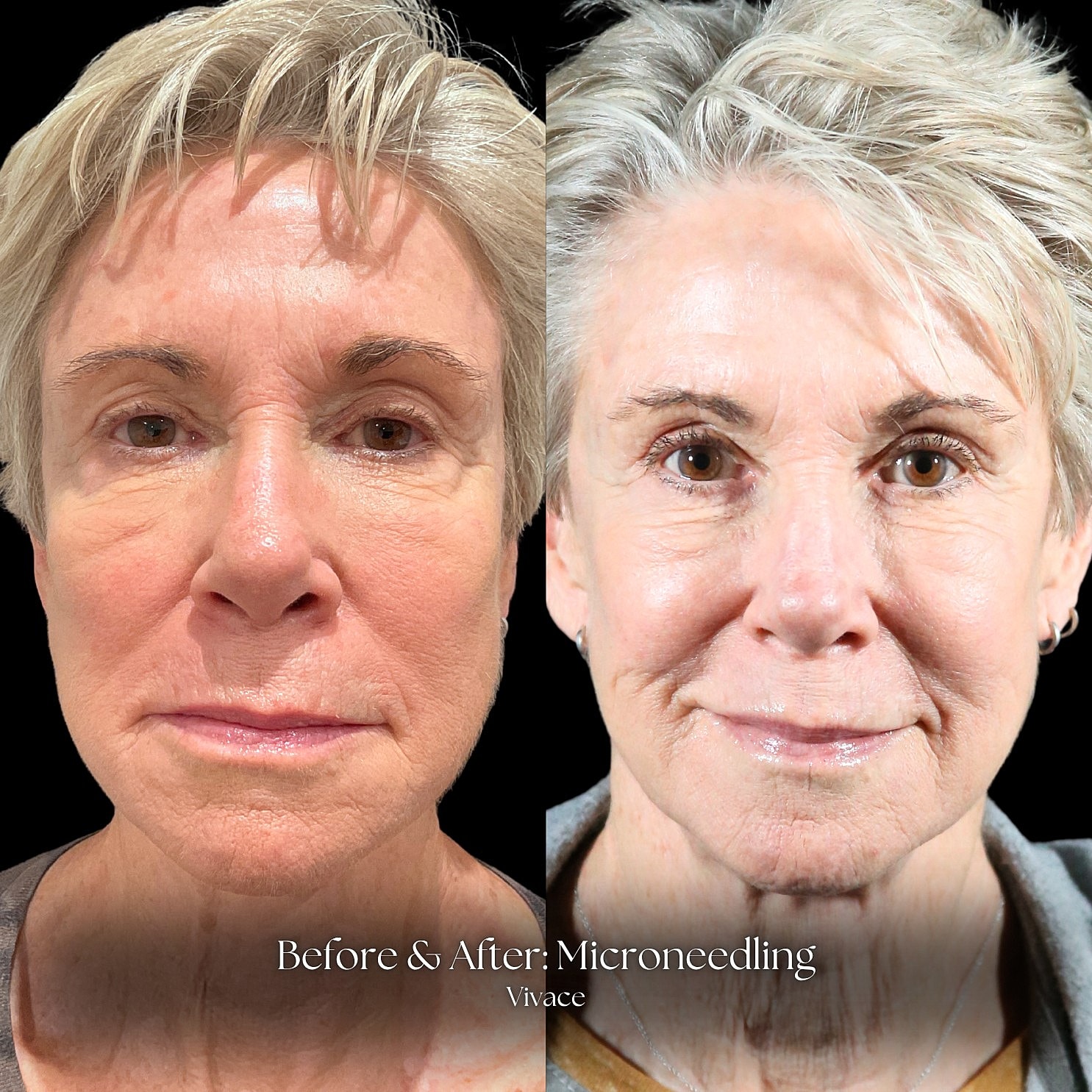 Microneedling Before & After