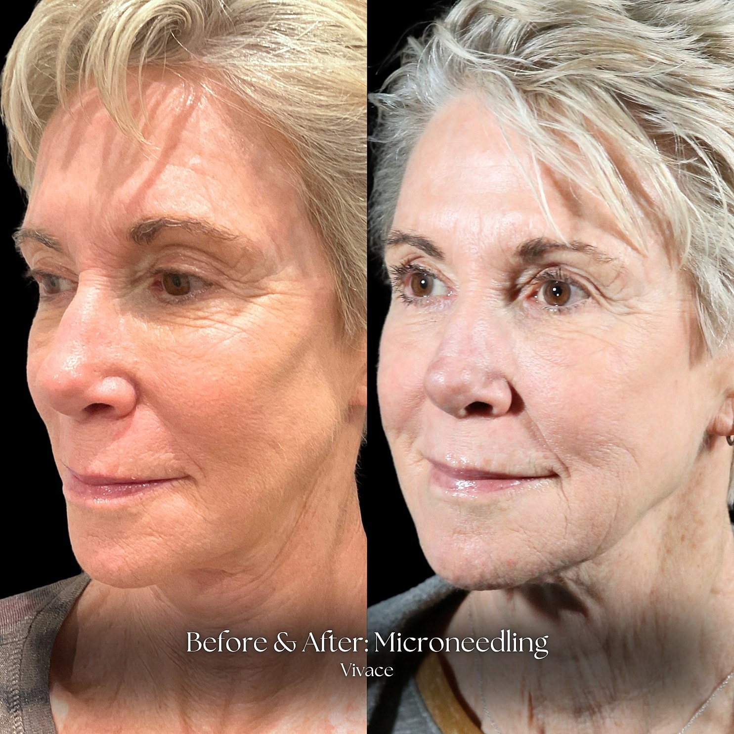 Microneedling Before & After