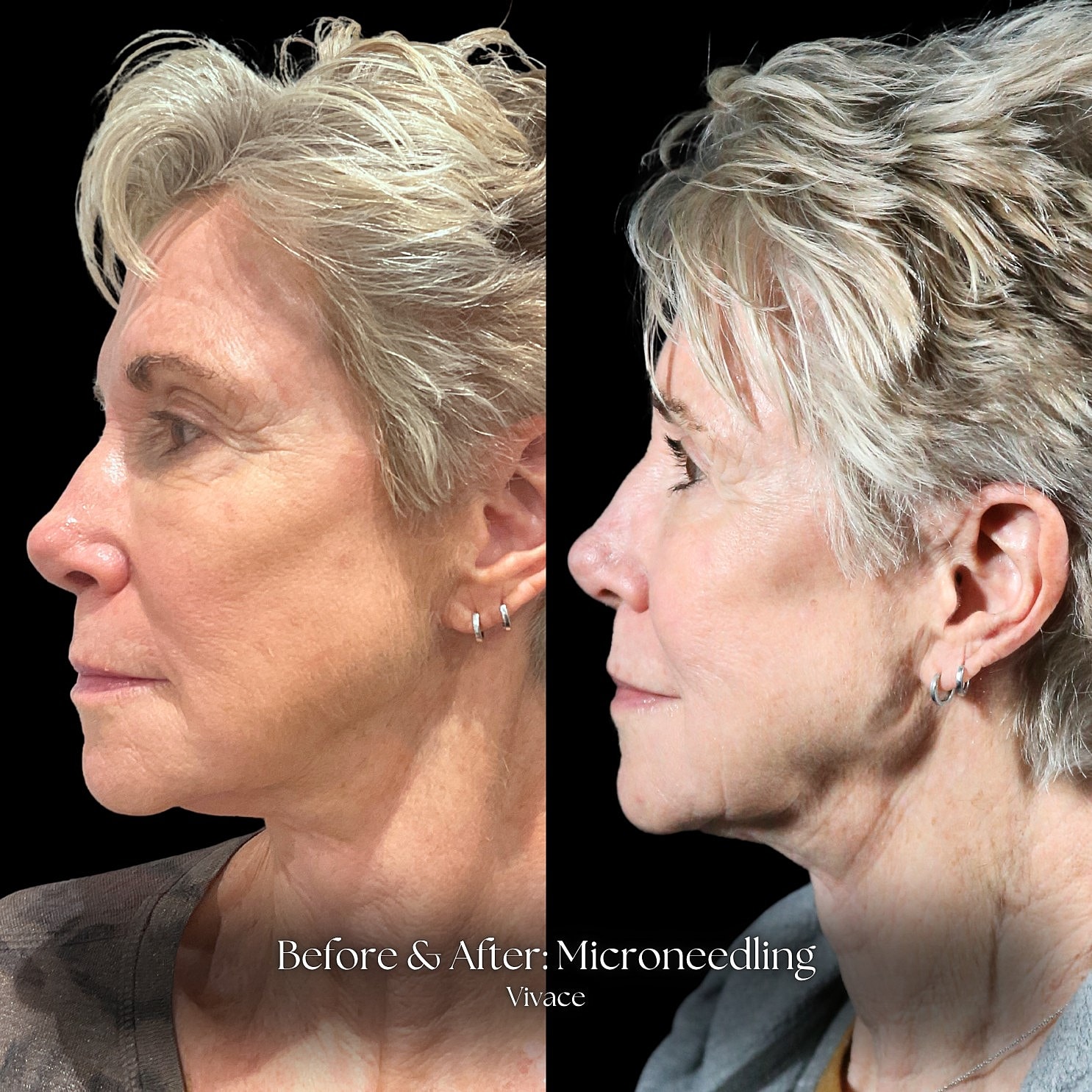 Microneedling Before & After