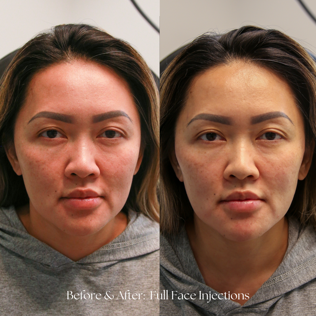Injectables | Full Facial Balancing Before & After