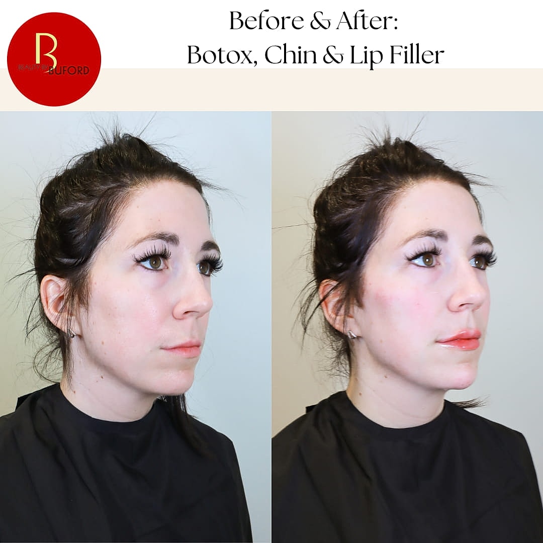 Before and after Botox and lip filler treatment.