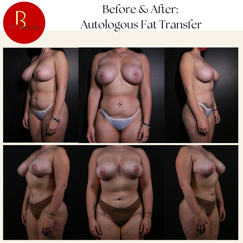 Before and after autologous fat transfer procedure.