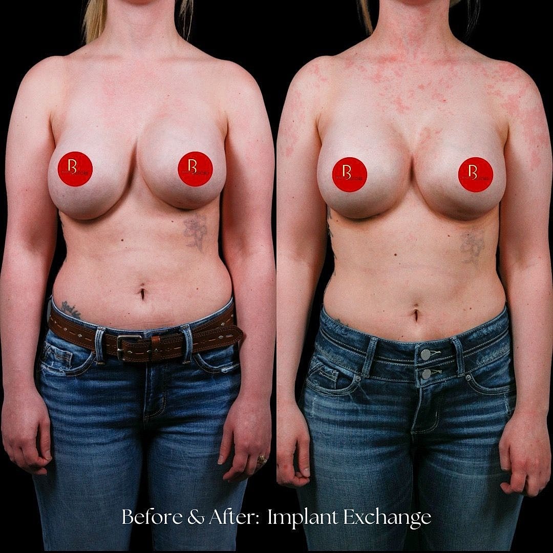 Before and after breast implant exchange comparison
