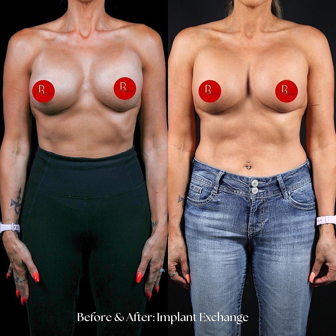 Before and after breast implant exchange comparison.