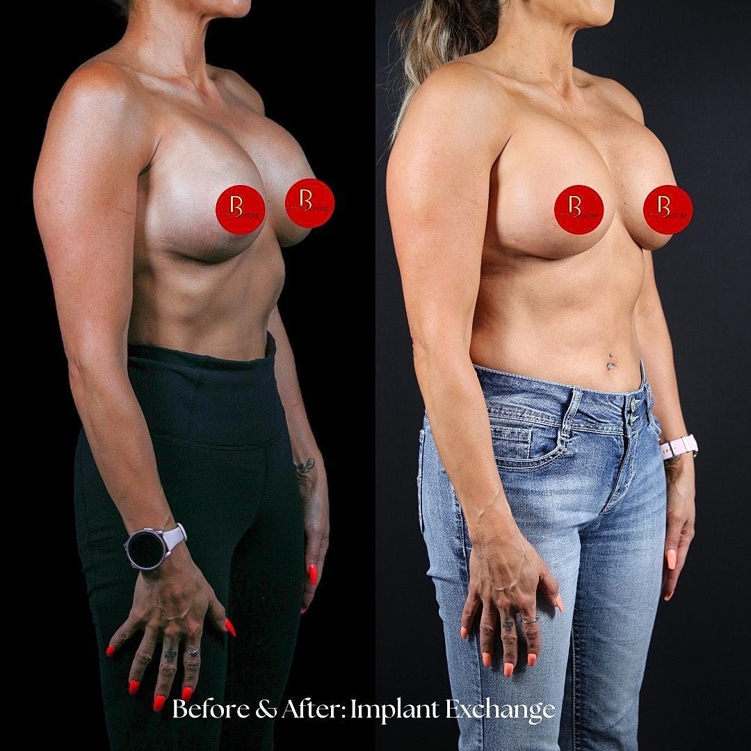 Before and after breast implant exchange comparison.