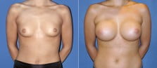 Breast Augmentation 1