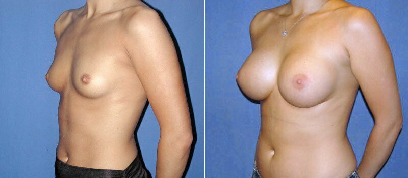 breast-augmentation-01b