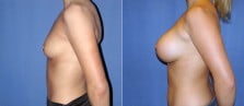 breast-augmentation-01c