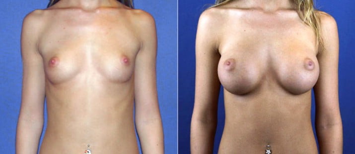 Breast Augmentation 5