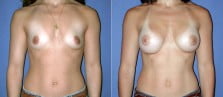 Breast Augmentation 6