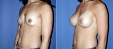 breast-augmentation-05b