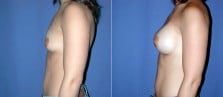 breast-augmentation-05c