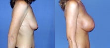 breast-augmentation-06c