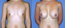 Breast Augmentation 8