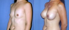breast-augmentation-10b