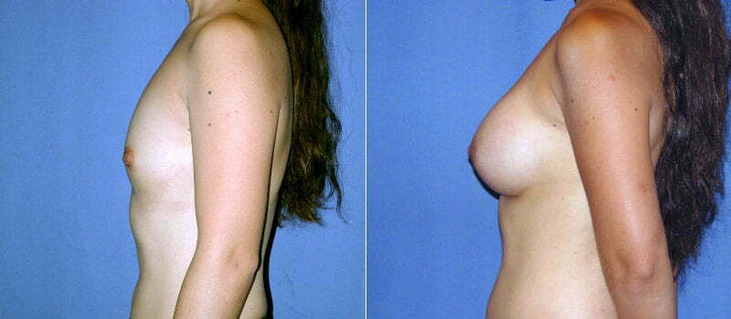 Breast Augmentation 8