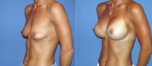 breast-augmentation-11b