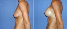 breast-augmentation-11c