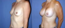 breast-augmentation-17b