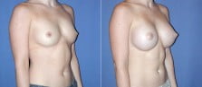 breast-augmentation-2-6b
