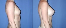 breast-augmentation-2-6c