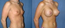 breast-augmentation-2-7b