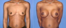 breast-augmentation-21a